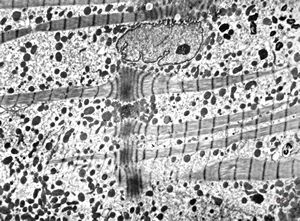 M,42y. | mild endocardial fibrosis - left ventricle (focal contractions of myofibrils) M,42y. | mild endocardial fibrosis - left ventricle (focal contractions of myofibrils)